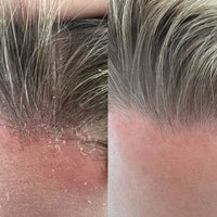 Scalp Essentials & Towel Set