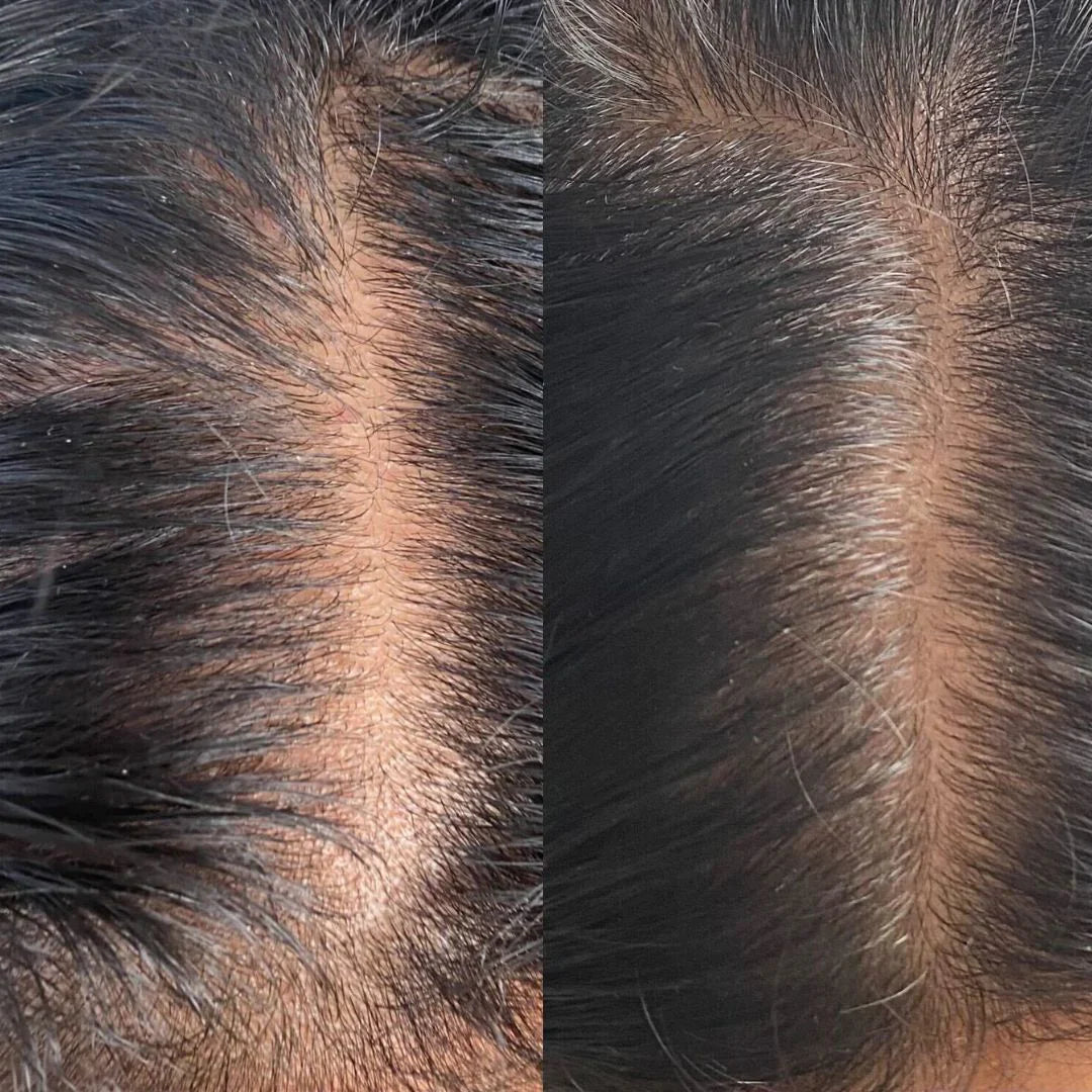 Advanced Scalp Care Starter Set